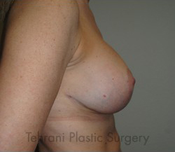 Breast Augmentation Before & After Patient #448