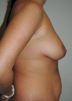 Breast Augmentation Before & After Patient #291