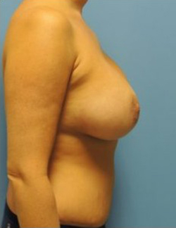 Breast Augmentation Before & After Patient #291