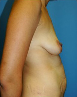 Breast Augmentation Before & After Patient #298