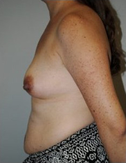 Breast Augmentation Before & After Patient #312