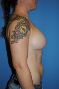 Breast Augmentation Before & After Patient #326