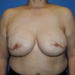 Breast Reconstruction Before & After Patient #455