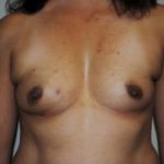 Breast Reconstruction Before & After Patient #465