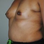 Breast Reconstruction Before & After Patient #465