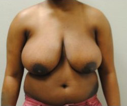 Breast Reduction Before & After Patient #479