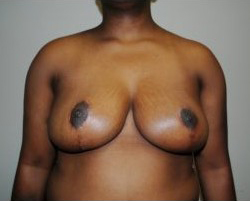 Breast Reduction Before & After Patient #479