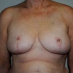 Breast Reduction Before & After Patient #486