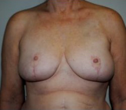 Breast Reduction Before & After Patient #486