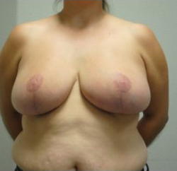 Breast Reduction Before & After Patient #493