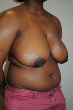 Breast Reduction Before & After Patient #479