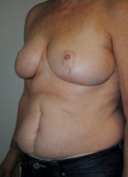 Breast Reduction Before & After Patient #486