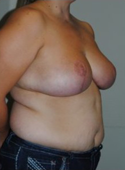 Breast Reduction Before & After Patient #493