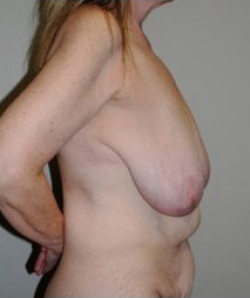 Breast Reduction Before & After Patient #472