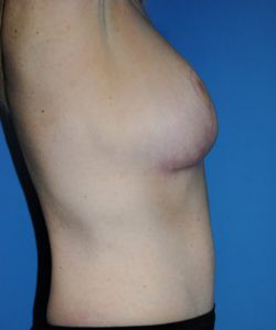 Breast Reduction Before & After Patient #472
