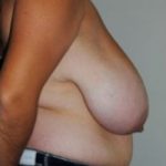 Breast Reduction Before & After Patient #493