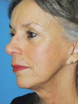 Face Lift and Neck Lift Before & After Patient #3808