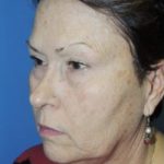 Face Lift and Neck Lift Before & After Patient #3813