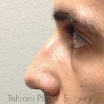 Rhinoplasty Before & After Patient #3818