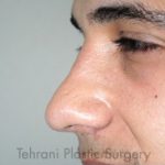 Rhinoplasty Before & After Patient #3818