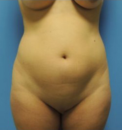 Slim Lipo / Liposuction Before & After Patient #156