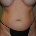 Slim Lipo / Liposuction Before & After Patient #163