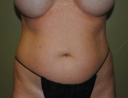 Slim Lipo / Liposuction Before & After Patient #163