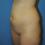 Slim Lipo / Liposuction Before & After Patient #156