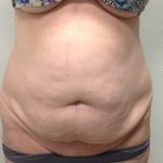 Tummy Tuck Before & After Patient #245