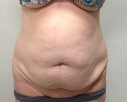 Tummy Tuck Before & After Patient #245