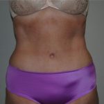 Tummy Tuck Before & After Patient #245