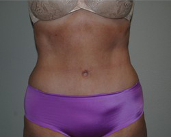 Tummy Tuck Before & After Patient #245