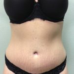 Tummy Tuck Before & After Patient #252