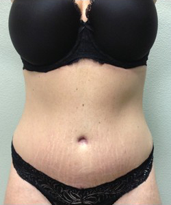 Tummy Tuck Before & After Patient #252