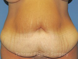 Tummy Tuck Before & After Patient #171