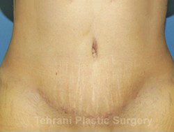 Tummy Tuck Before & After Patient #171
