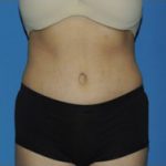 Tummy Tuck Before & After Patient #183