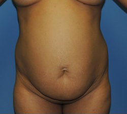 Tummy Tuck Before & After Patient #190
