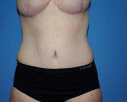 Tummy Tuck Before & After Patient #213