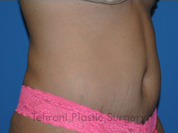 Tummy Tuck Before & After Patient #176