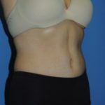 Tummy Tuck Before & After Patient #183