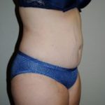 Tummy Tuck Before & After Patient #197