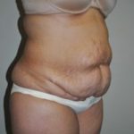 Tummy Tuck Before & After Patient #204