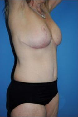 Tummy Tuck Before & After Patient #213