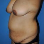 Tummy Tuck Before & After Patient #238