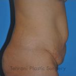 Tummy Tuck Before & After Patient #176