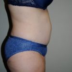 Tummy Tuck Before & After Patient #197