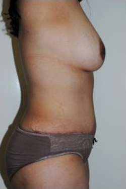 Tummy Tuck Before & After Patient #204