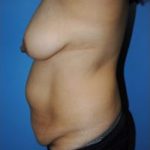 Tummy Tuck Before & After Patient #238