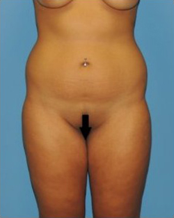 Vaser Liposuction Before & After Patient #259